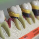 下赤塚（練馬区田柄）の歯医者、藤山歯科クリニックで歯周病の急性発作についての解説