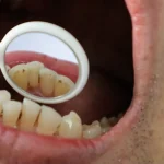 下赤塚（練馬区田柄）の歯医者、藤山歯科クリニックで前歯の裏側に歯石がつきやすい理由と落とす方法を解説