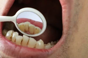 下赤塚（練馬区田柄）の歯医者、藤山歯科クリニックで前歯の裏側に歯石がつきやすい理由と落とす方法を解説